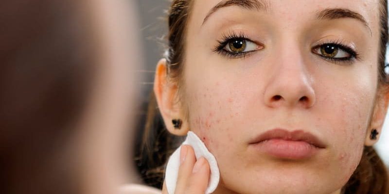 Should I Seek Treatment For My Acne Scarring?
