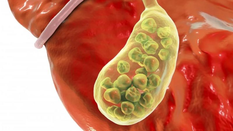 Gallbladder stone: What are the symptoms?