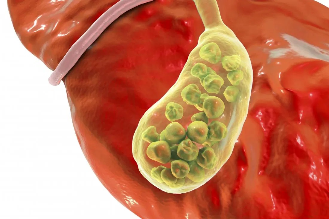 Gallbladder stone: What are the symptoms?