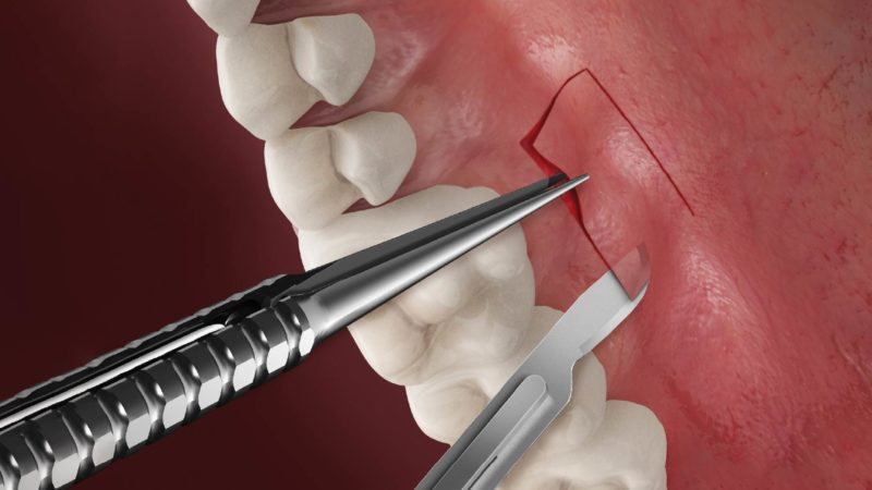 The Science Behind Gingival Grafts in Fairfield: Regenerating Healthy Gums
