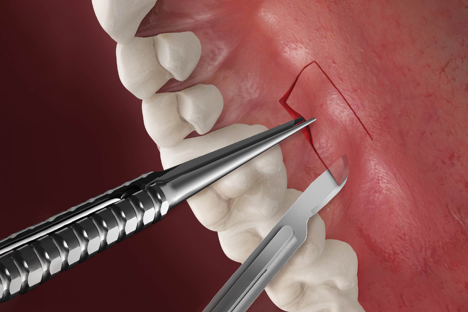 The Science Behind Gingival Grafts in Fairfield: Regenerating Healthy Gums