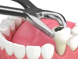 Root Canal Therapy: Does It Prevent The Need For Extraction?