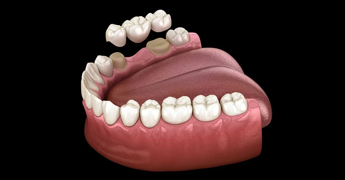 Bridges vs. Crowns: Which Dental Solution is Right for You?